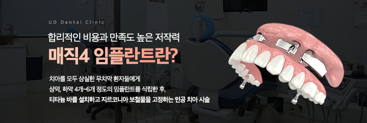 매직4 임플란트란