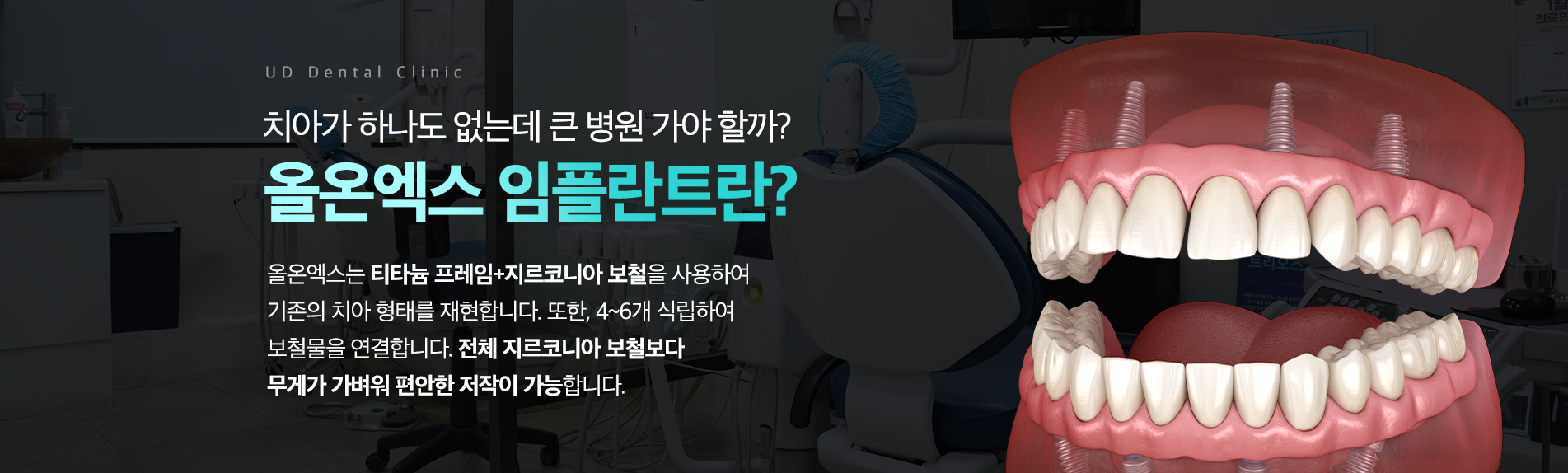 올온엑스 임플란트란?
