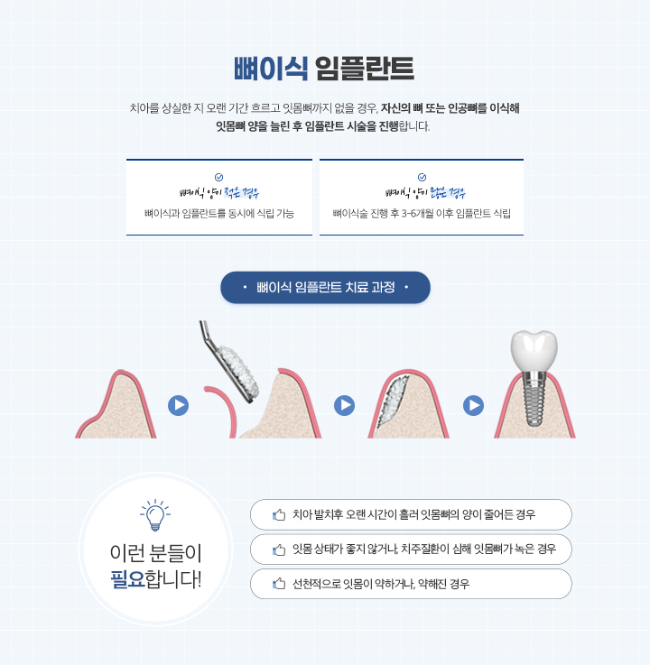 뼈이식임플란트