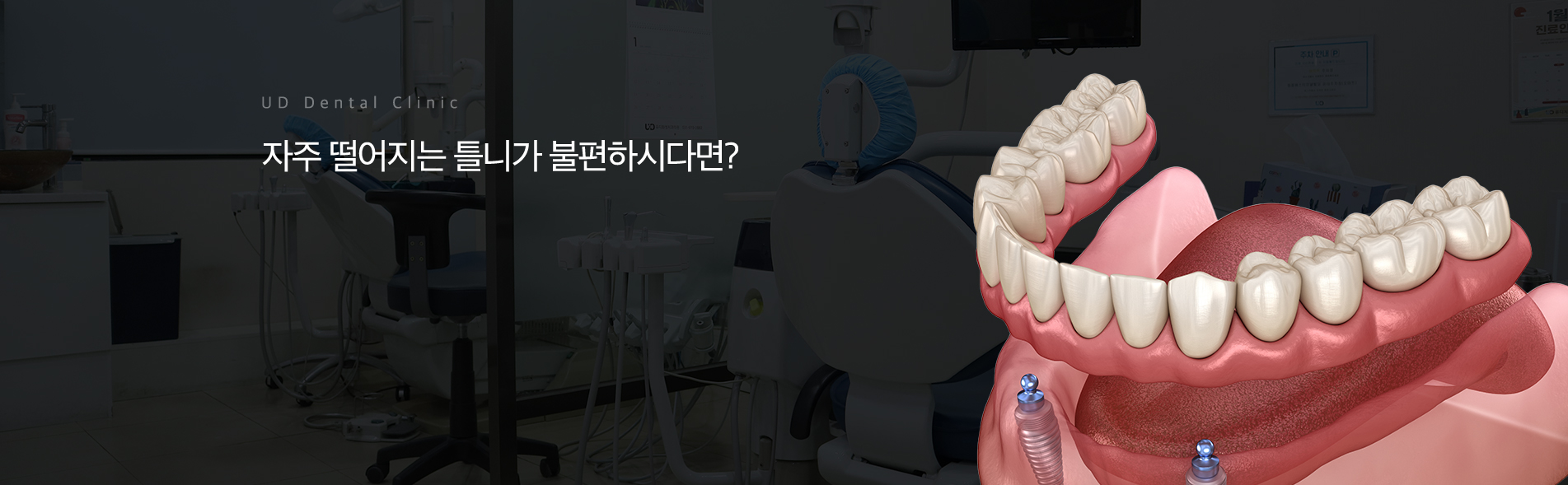 임플란트틀니